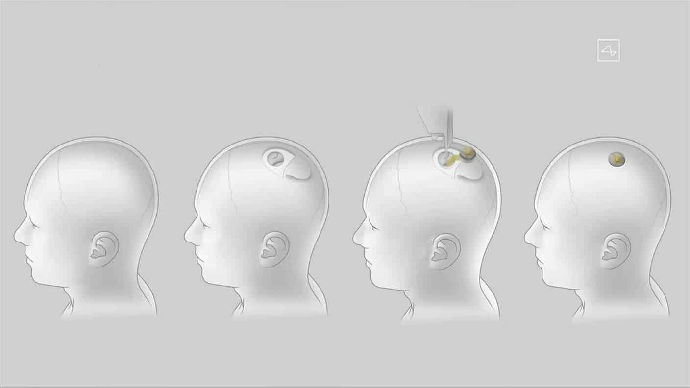 Neuralink brain implants